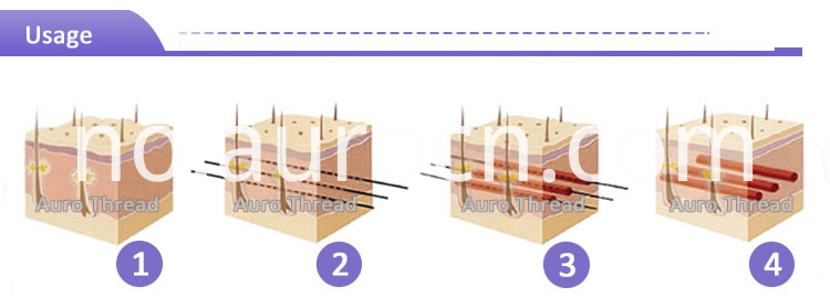 Trådløft Thread lifting